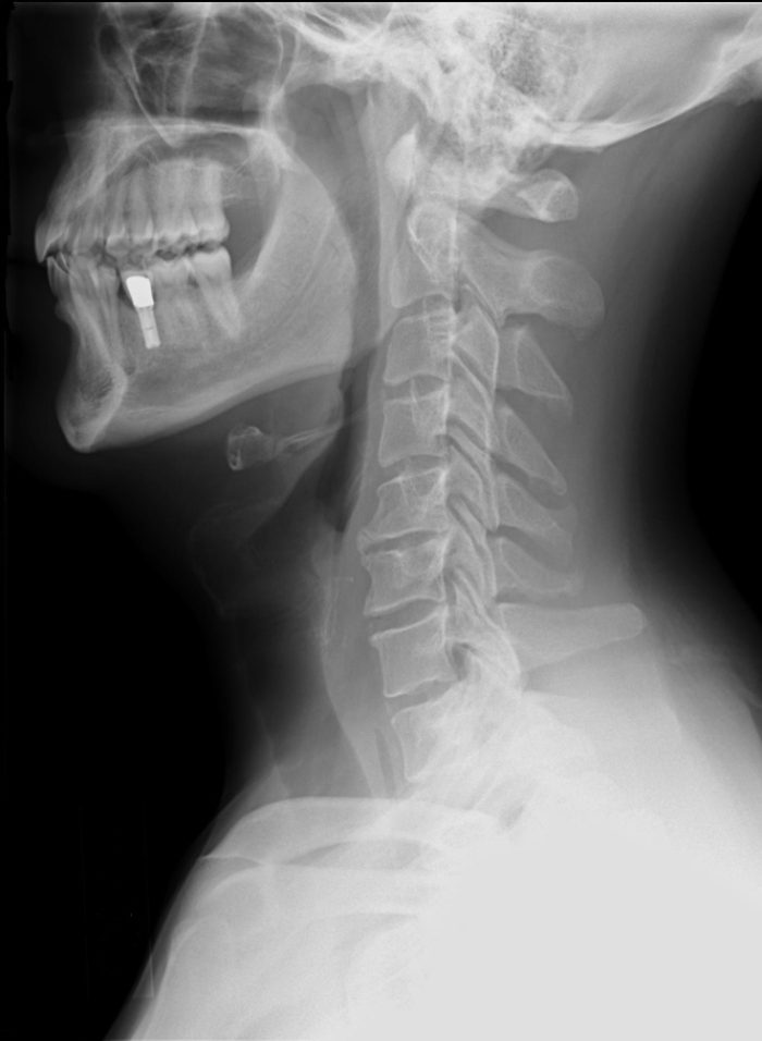 Lateral X-ray of the cervical spine, reference image