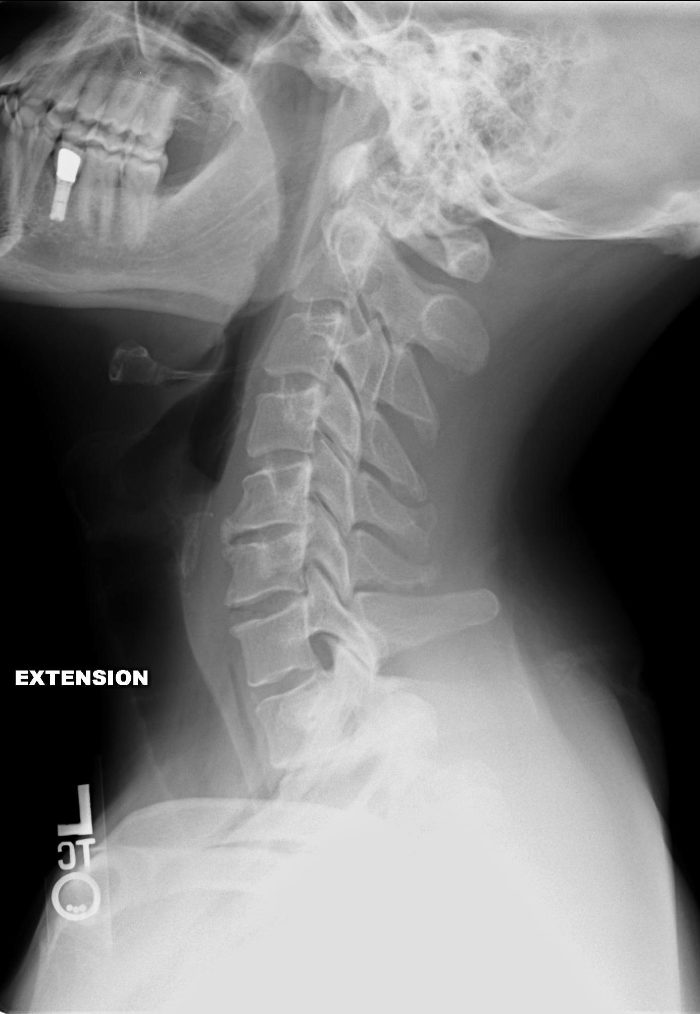 Cervical spine X-ray in extension, reference image