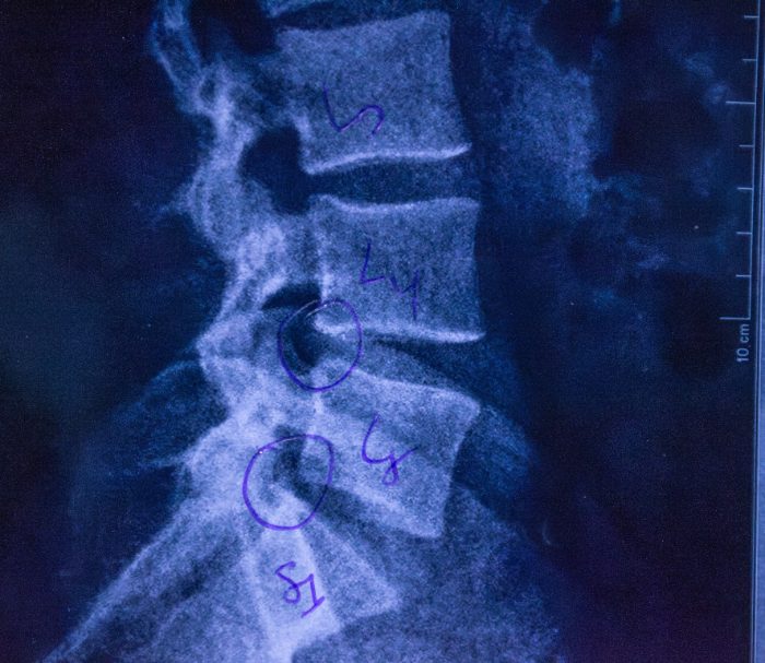 Lumbar spine imaging showing disc herniation, reference image