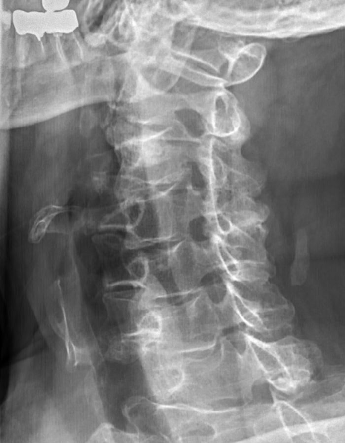 Cervical X-ray showing foraminal narrowing, reference image